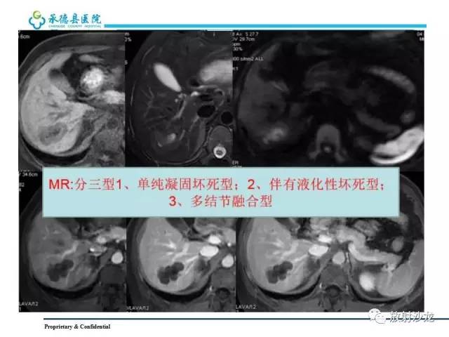 【PPT】肝脏常见占位性病变影像表现及诊断思路