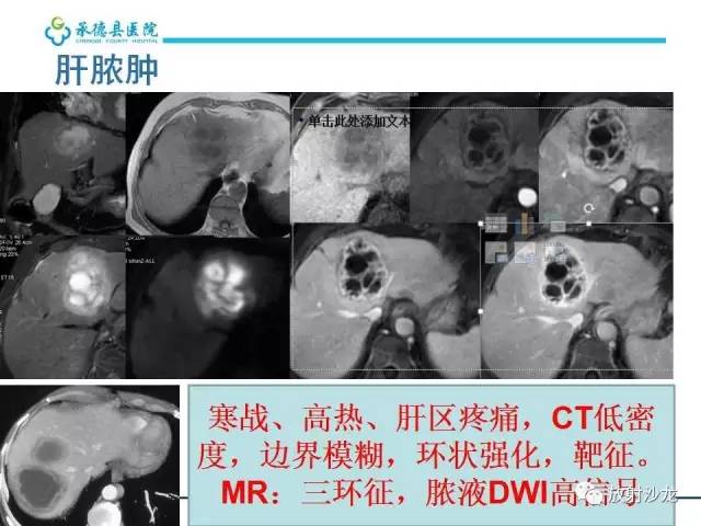 【PPT】肝脏常见占位性病变影像表现及诊断思路