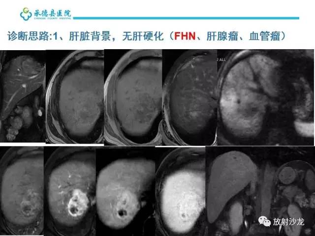【PPT】肝脏常见占位性病变影像表现及诊断思路