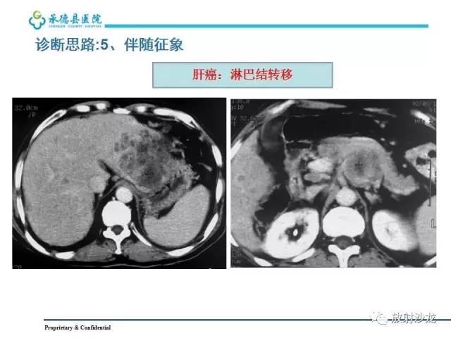 【PPT】肝脏常见占位性病变影像表现及诊断思路