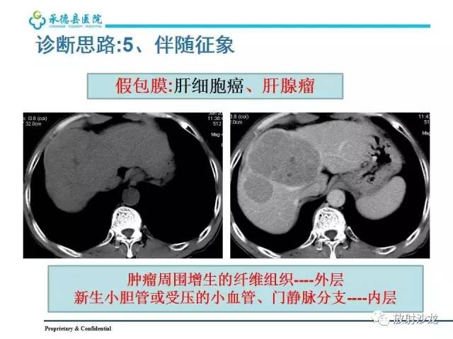 【PPT】肝脏常见占位性病变影像表现及诊断思路