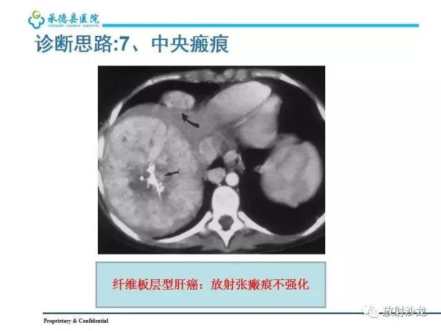 【PPT】肝脏常见占位性病变影像表现及诊断思路