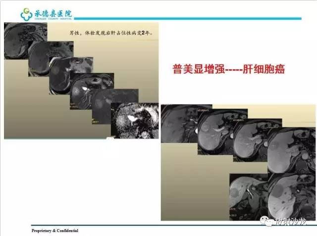 【PPT】肝脏常见占位性病变影像表现及诊断思路
