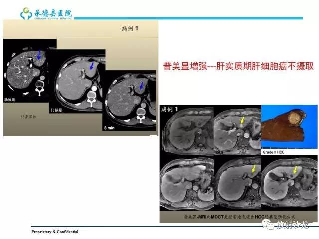 【PPT】肝脏常见占位性病变影像表现及诊断思路
