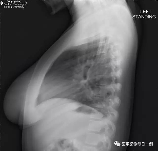 【病例】肺隔离症伴感染1例CT影像表现 【病例】肺隔离症伴感染1例CT影像表现