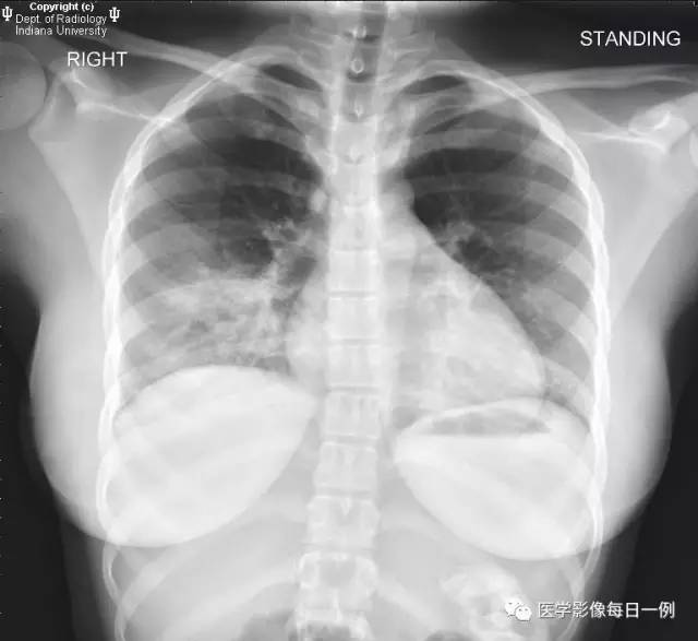【病例】肺隔离症伴感染1例CT影像表现 【病例】肺隔离症伴感染1例CT影像表现