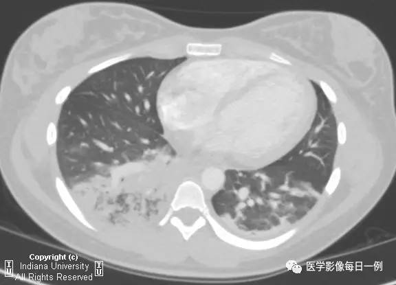 【病例】肺隔离症伴感染1例CT影像表现 【病例】肺隔离症伴感染1例CT影像表现