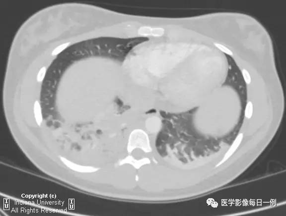 【病例】肺隔离症伴感染1例CT影像表现 【病例】肺隔离症伴感染1例CT影像表现