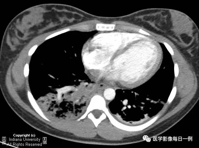 【病例】肺隔离症伴感染1例CT影像表现 【病例】肺隔离症伴感染1例CT影像表现