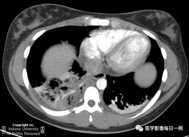 【病例】肺隔离症伴感染1例CT影像表现 【病例】肺隔离症伴感染1例CT影像表现
