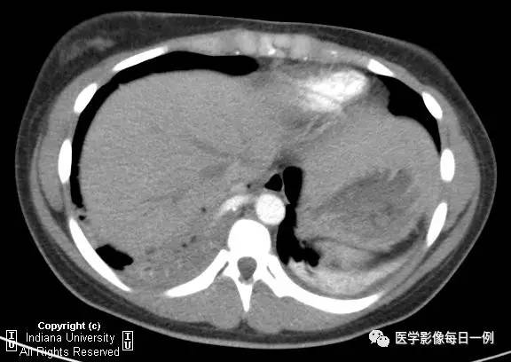 【病例】肺隔离症伴感染1例CT影像表现 【病例】肺隔离症伴感染1例CT影像表现