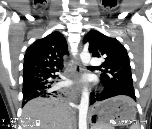 【病例】肺隔离症伴感染1例CT影像表现 【病例】肺隔离症伴感染1例CT影像表现