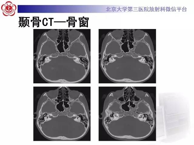 【病例】科凯恩综合征1例CT及MR