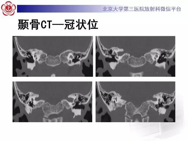 【病例】科凯恩综合征1例CT及MR