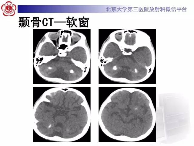 【病例】科凯恩综合征1例CT及MR