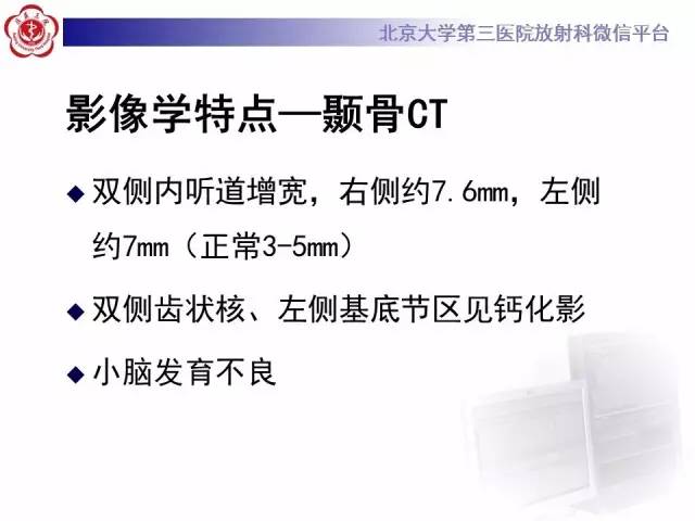 【病例】科凯恩综合征1例CT及MR