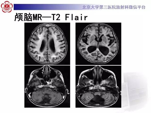 【病例】科凯恩综合征1例CT及MR