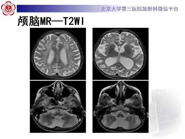 【病例】科凯恩综合征1例CT及MR