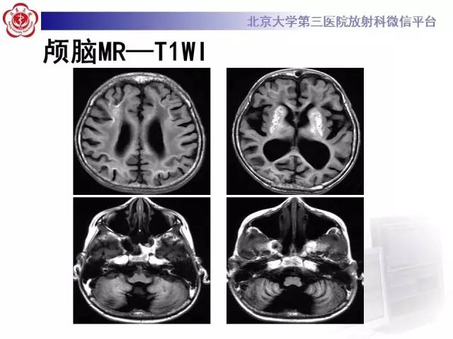 【病例】科凯恩综合征1例CT及MR