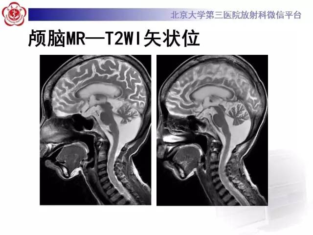 【病例】科凯恩综合征1例CT及MR