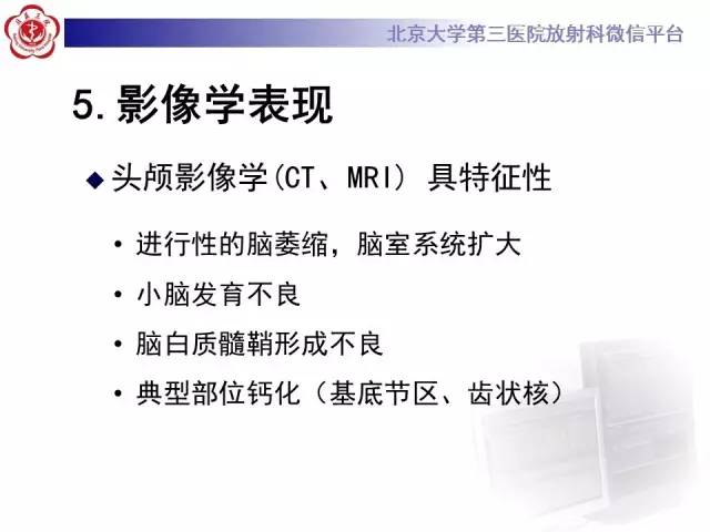 【病例】科凯恩综合征1例CT及MR