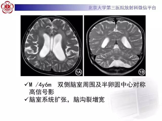 【病例】科凯恩综合征1例CT及MR