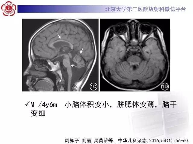 【病例】科凯恩综合征1例CT及MR