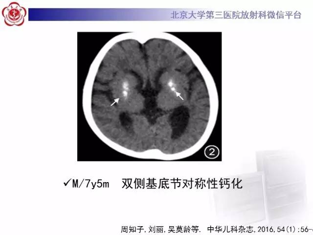 【病例】科凯恩综合征1例CT及MR