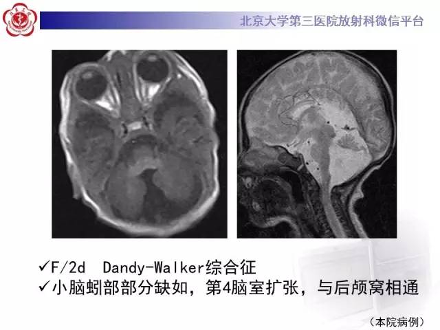 【病例】科凯恩综合征1例CT及MR