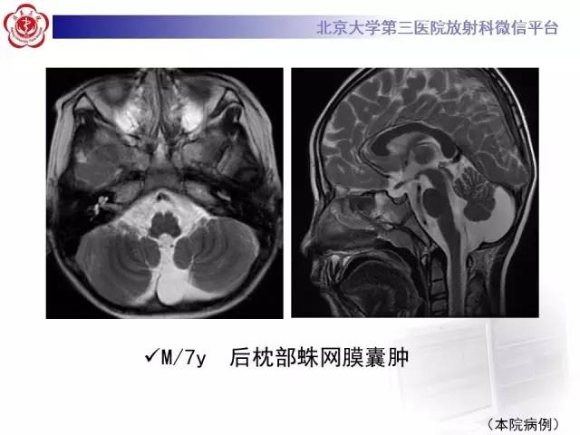 【病例】科凯恩综合征1例CT及MR