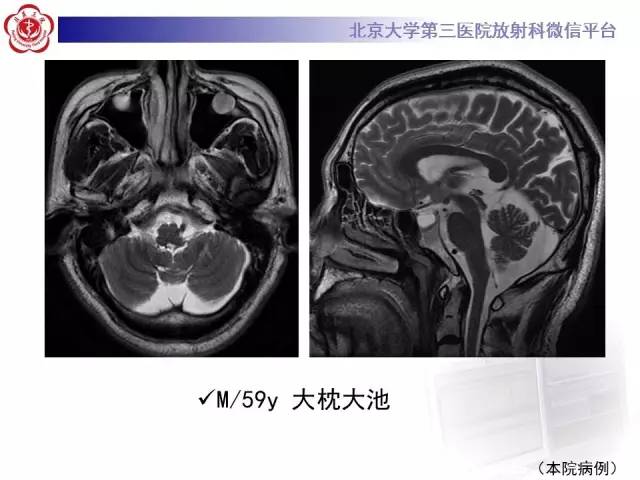 【病例】科凯恩综合征1例CT及MR