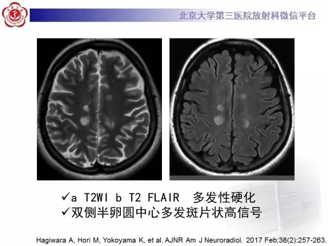 【病例】科凯恩综合征1例CT及MR