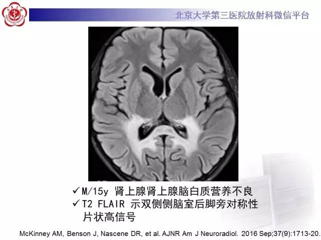 【病例】科凯恩综合征1例CT及MR