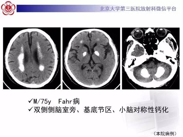 【病例】科凯恩综合征1例CT及MR