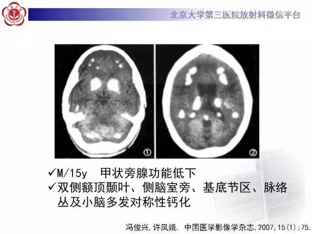 【病例】科凯恩综合征1例CT及MR