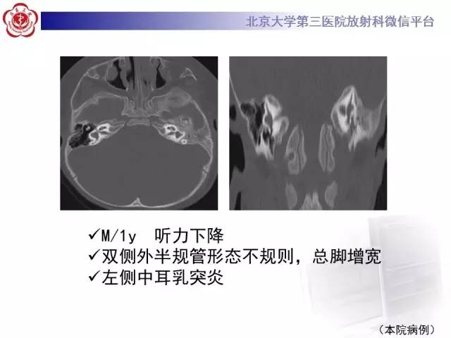 【病例】科凯恩综合征1例CT及MR