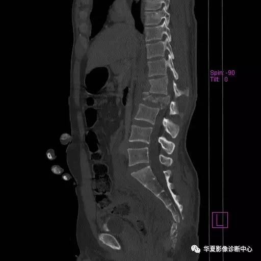 原来椎体压缩骨折与爆裂骨折的差别是酱紫的，你的报告对了吗？