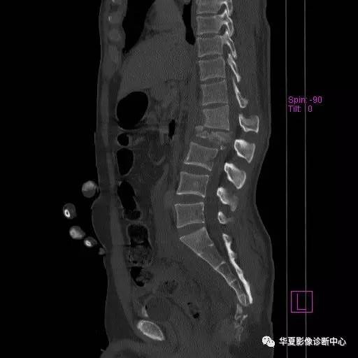 原来椎体压缩骨折与爆裂骨折的差别是酱紫的，你的报告对了吗？