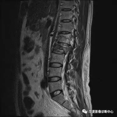 原来椎体压缩骨折与爆裂骨折的差别是酱紫的，你的报告对了吗？