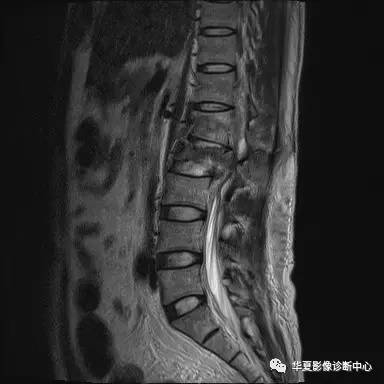 原来椎体压缩骨折与爆裂骨折的差别是酱紫的，你的报告对了吗？