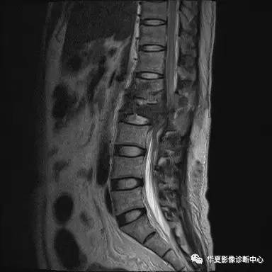 原来椎体压缩骨折与爆裂骨折的差别是酱紫的，你的报告对了吗？