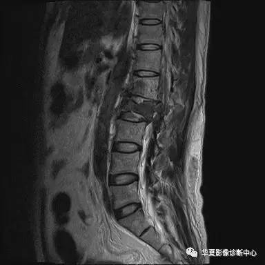 原来椎体压缩骨折与爆裂骨折的差别是酱紫的，你的报告对了吗？