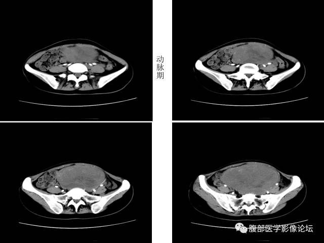 【病例】卵巢无性细胞瘤1例CT影像表现 【病例】卵巢无性细胞瘤1例CT影像表现