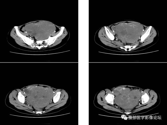 【病例】卵巢无性细胞瘤1例CT影像表现 【病例】卵巢无性细胞瘤1例CT影像表现
