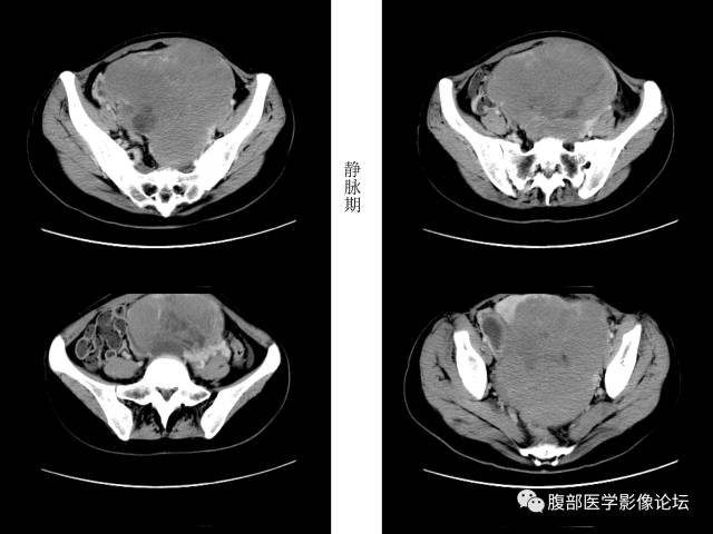 【病例】卵巢无性细胞瘤1例CT影像表现 【病例】卵巢无性细胞瘤1例CT影像表现