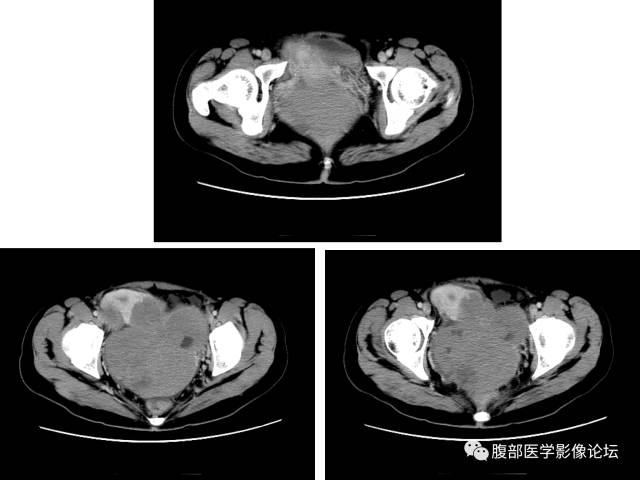 【病例】卵巢无性细胞瘤1例CT影像表现 【病例】卵巢无性细胞瘤1例CT影像表现