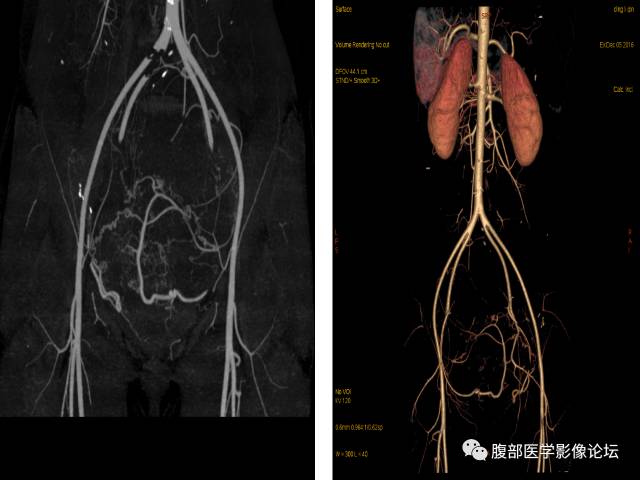 【病例】卵巢无性细胞瘤1例CT影像表现 【病例】卵巢无性细胞瘤1例CT影像表现