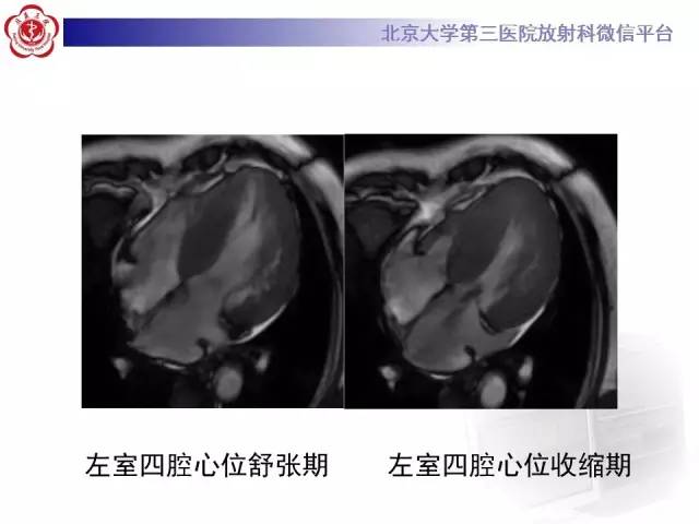 【病例】肥厚性心肌病1例MR影像表现