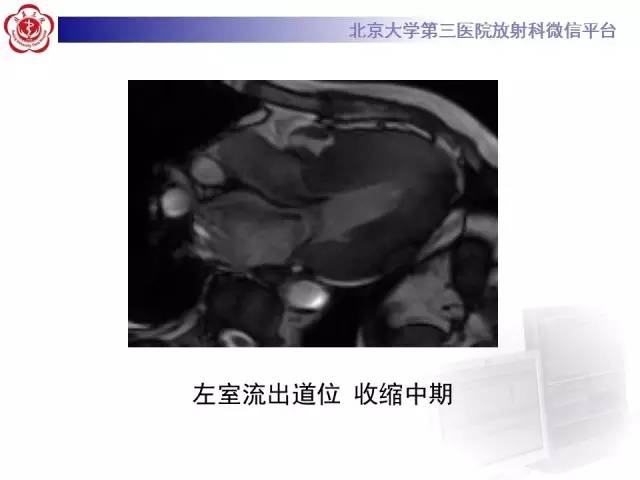 【病例】肥厚性心肌病1例MR影像表现