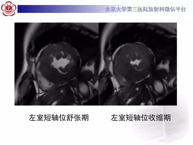 【病例】肥厚性心肌病1例MR影像表现